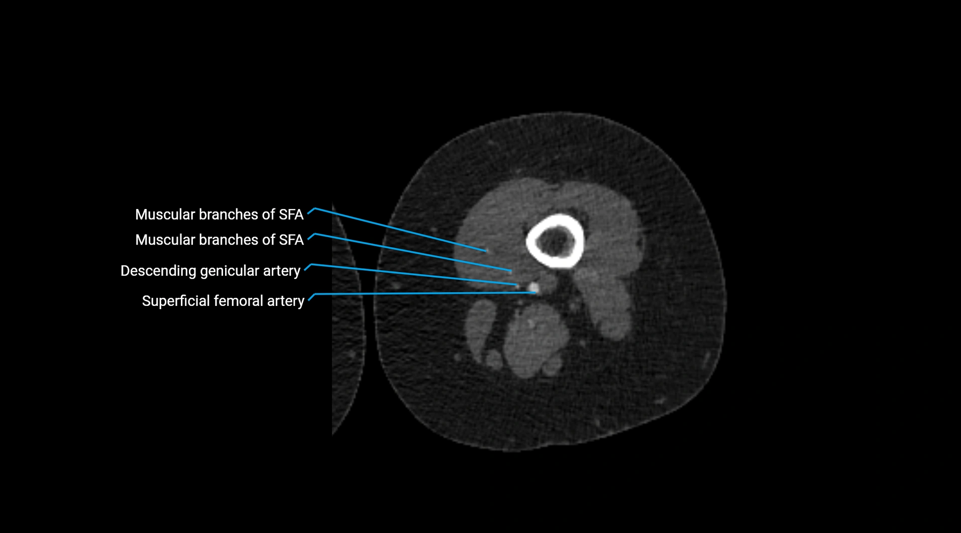 CTA lower limb cross sectional anatomy labelled image _149.webp